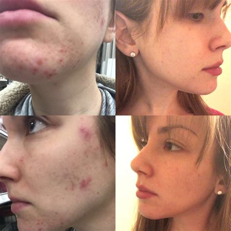 vitamin  acne   vitamin   skin health