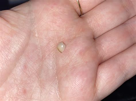 a chunk of my rotten tooth fell out… : r/askdentists