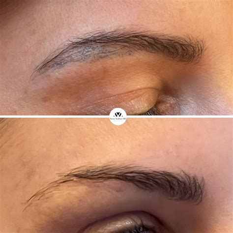 The Benefits Of Using Picosure Laser To Remove Microbladed Eyebrows