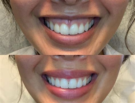 Lip Filler Aftercare: 7 Must-Know Tips for Beautifully Plump Lips!