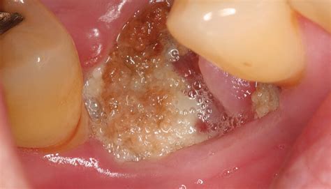 Addressing Medication-Related Osteonecrosis of the Jaw - Dimensions of Dental Hygiene