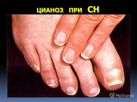 Презентация на тему: "ПатофизиологиясердечнойНедостаточности Доцент ...