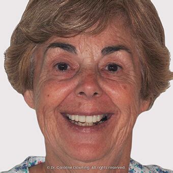 Annette - Smile Docs Lindfield - Dr. Caroline Downing