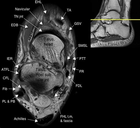 Normal Magnetic Resonance Imaging Anatomy of the Ankle & Foot ...