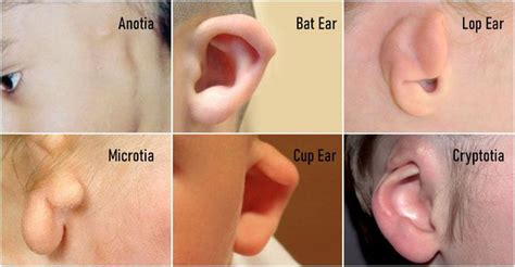 developmental disorders   ear medizzy