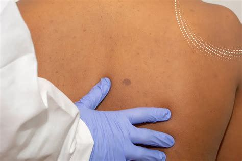 Neurofibromatosis: Diagnosis and Treatment Overview