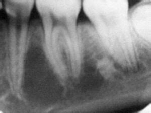 simple bone cyst traumatic cyst ddmfr