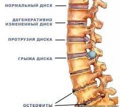 Грыжа межпозвонковая / Лечение остеохондроза