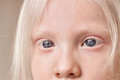 Albino Eye Color: Understanding Its Unique Appearance