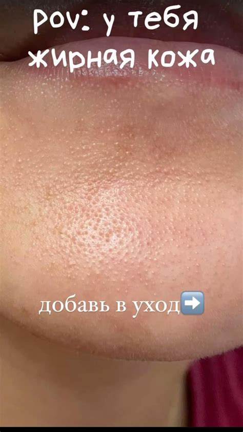 уход за жирной кожей лица 🤍