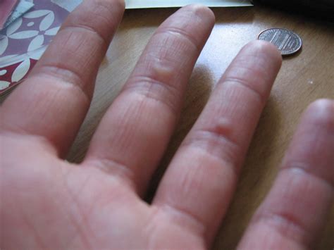 precautions  drumming blisters  currentyear