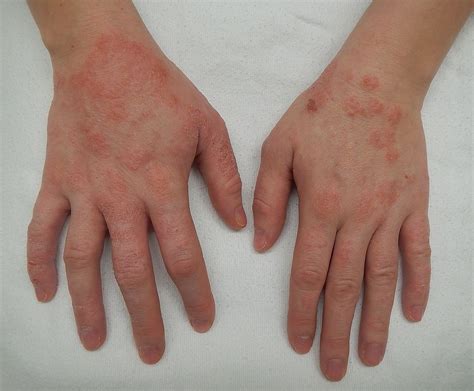 Dermatitas – Vikipedija