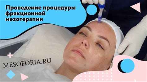 Видео по проведению процедуры фракционной мезотерапии - YouTube