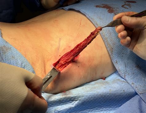 Technical Strategies - The Role of Latissimus Dorsi Muscle Removal In