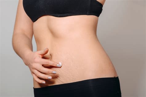 Using palmers lotions every day can heal your stretch marks 24