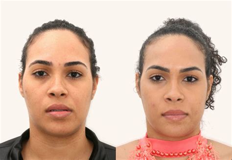 Assimetria Facial Antes E Depois - Cirurgia Facial Assimetrica Antes E Depois