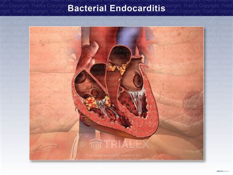 bacterial endocarditis trialquest