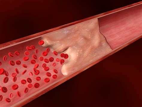 Comment soigner la calcification des artères ? - CM 35