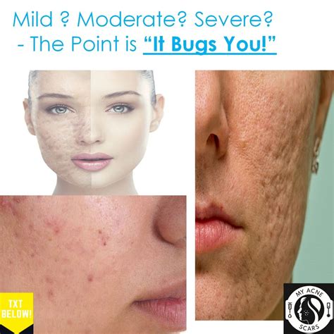 Very Mild Acne Scars