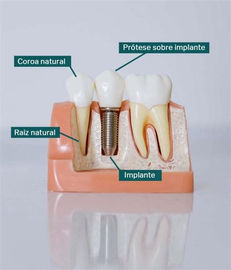 Como Funciona Um Implante Dentário? - Oral Unic