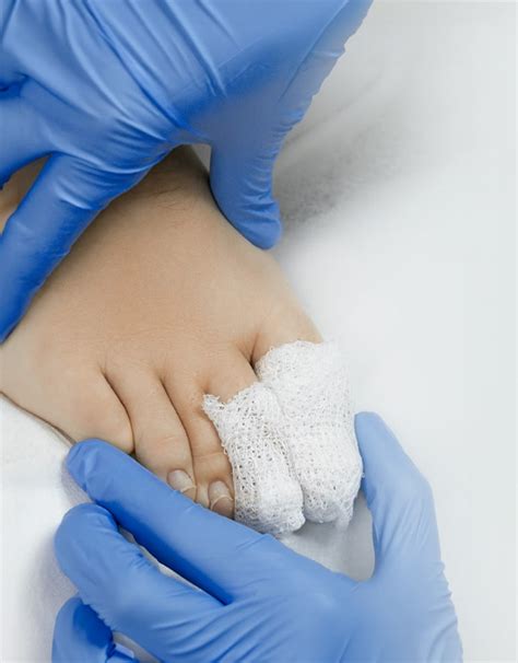 Diabetic Foot Ulcer Treatment, Medication, Ointment, Antibiotics