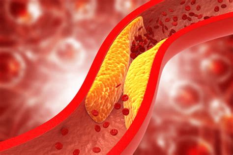 Arterial Blockage - Modern Heart and Vascular