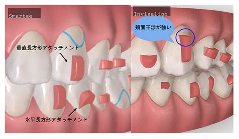 invisalignsmarteepro