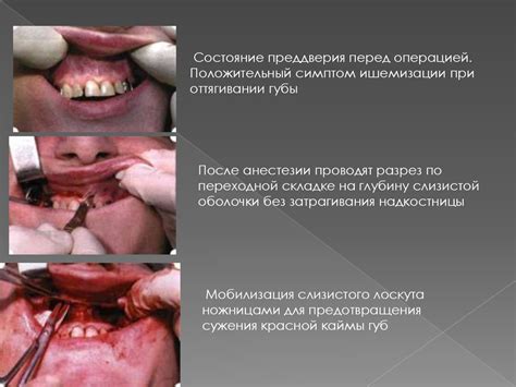 Операции при мелком преддверии полости рта. Френулопластика ...