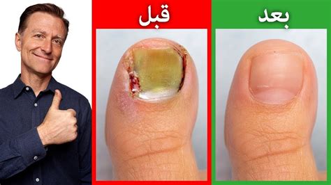 كيفية علاج فطريات أظافر القدم بأقل تكلفة ممكنة - YouTube