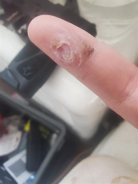 does it look like the wart is gone : medical_advice
