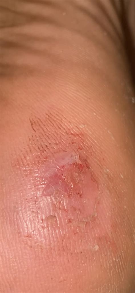 Day 6 of avc treatment on planter wart - I’ve had this for years and