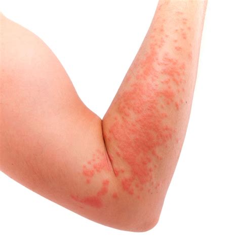 Alergia al sol: causas, síntomas y tratamientos