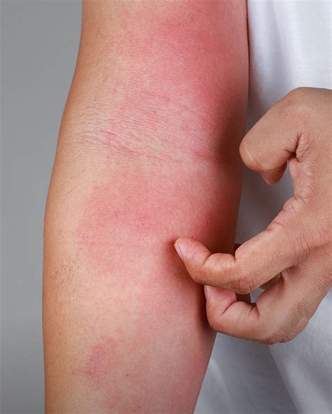 Allergy Experts - New York Allergy & Asthma | New York NY