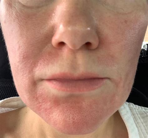 iPixel Fractional Laser Skin Resurfacing - Hertfordshire - Aqua-Tox
