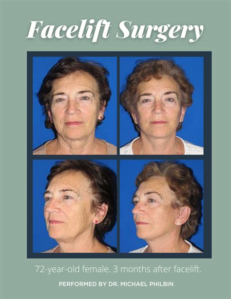 week facelift recovery guide edina plastic surgery