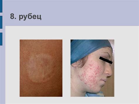 Морфологические элементы сыпи - презентация онлайн