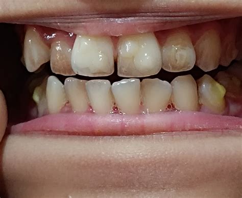 Help please!! My teeth look weird : r/Invisalign