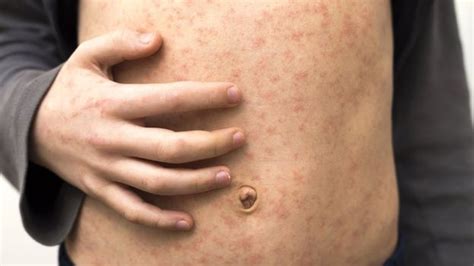 Sarampo faz corpo 'esquecer' como combater infecções, dizem cientistas ...