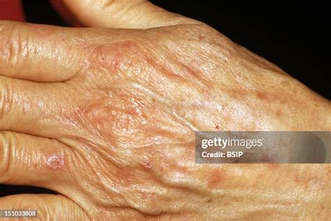 Porphyria Cutanea Tarda Photos and Premium High Res Pictures - Getty Images