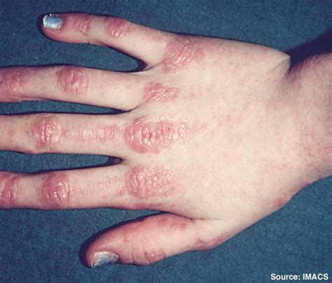 Kuva dermatomyosiitista - Iho-Ongelmat-Ja-Hoidot 2024