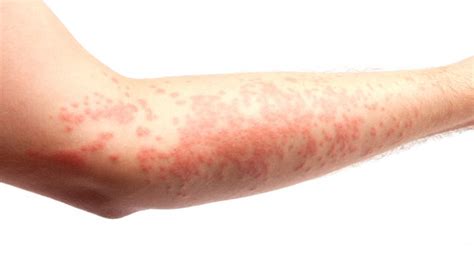 Skin Allergies - Paris Asthma and Allergy Centers