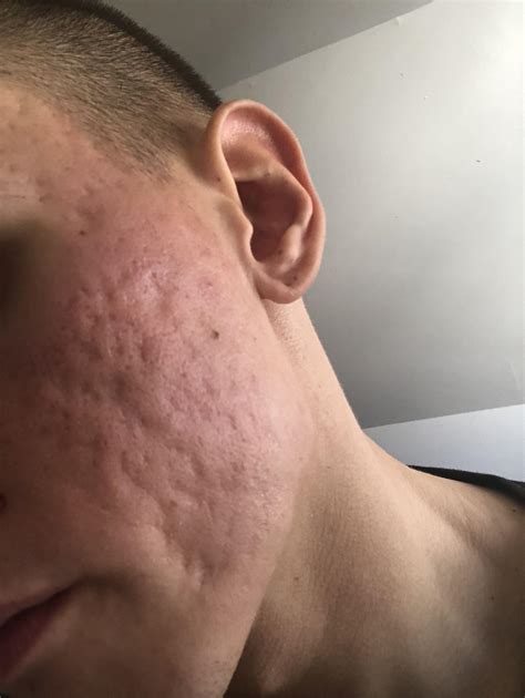 Moderate Acne Scars