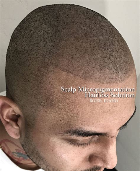 Scalp Micro Boise | Garden City ID