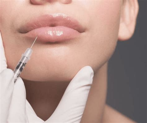 Filler Migration 101 - Simply Clinics