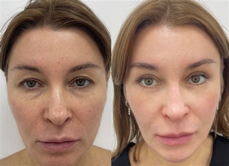 Эндоскопическая подтяжка лба и бровей в VIP Clinic. Цены на лифтинг ...