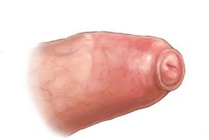 Тээрхийн арьсны нарийсал буюу фимоз | MedBook.mn