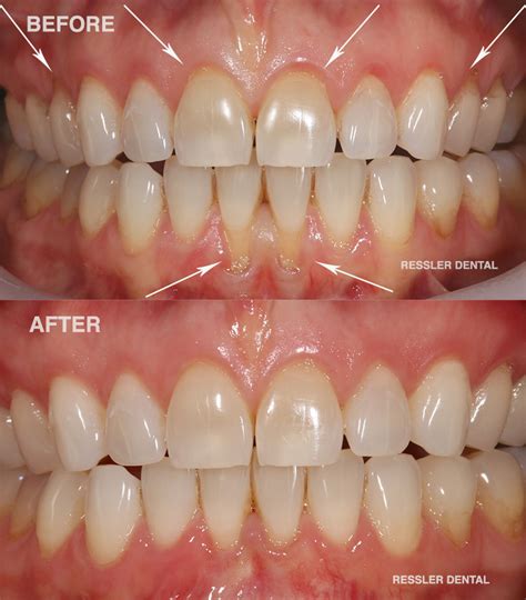 Receding Gum Line How to Fix Receding Gum Line With These Powerful ...