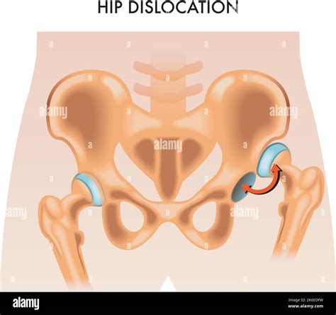 Medizinische illustration hüftgelenk -Fotos und -Bildmaterial in hoher ...