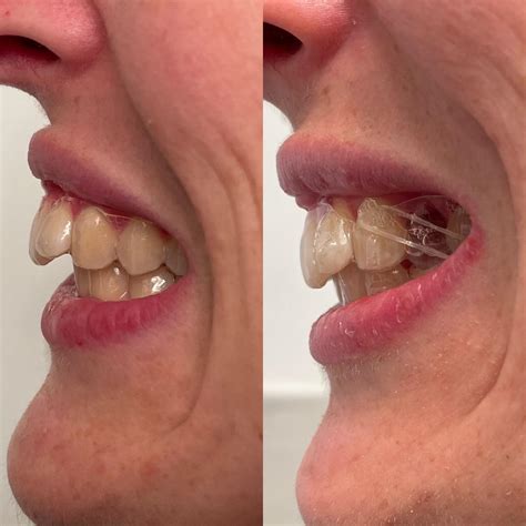 17/52+ week progress to correct an overjet and crowding : r/Invisalign