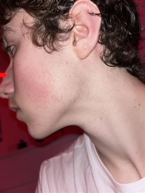 Is this Keratosis Pilaris on my Face? : r/keratosis